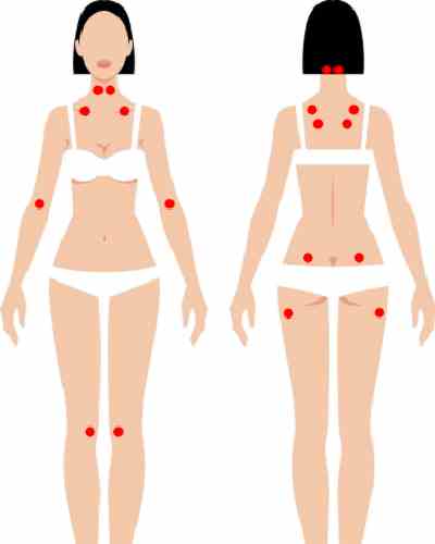 Points fibromyalgie