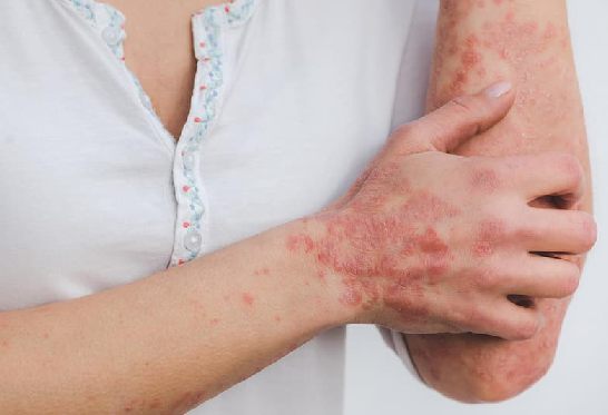 Femme qui est démangée par son psoriasis, solutions naturelles